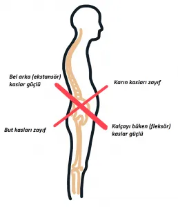 Bel Ağrılarının Az Bilinen Bir Nedeni: Alt Çapraz Sendromu