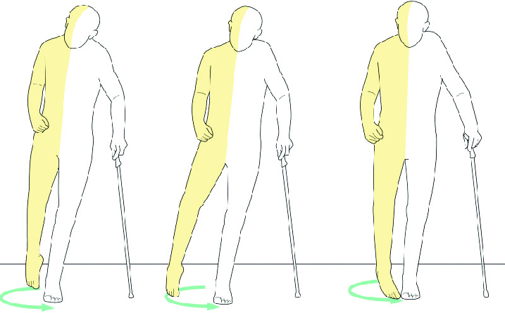 Felçli hastalarda çok sık görülen bir yürüme paterni ise oraklama yürüyüşüdür. Bu paternde kalça ve dizi yeterince bükemeyen ve ayağı yerden kaldıramayan hastalar, leğen kemiğinden itibaren bacaklarını yandan oraklayarak adım alırlar.