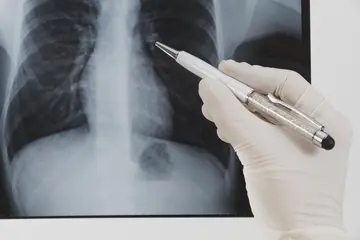 Göğüs Ağrısının Kalp ve Akciğer Dışı Nedenleri