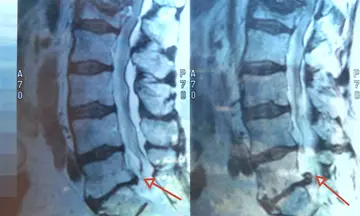 Bel Kanal Daralması – Lomber Spinal Stenoz