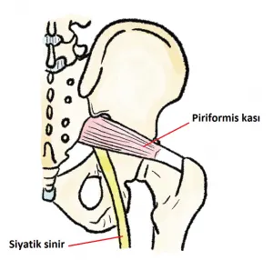 Bel Fıtığı mı, Piriformis Sendromu mu?