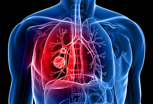 akciğer tümörü