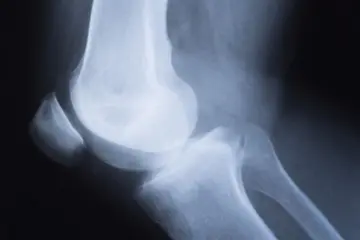 Diz Kapağı Çıkığı Nedir? Belirtileri ve Tedavisi