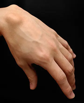 Kist Nedir? Neden Olur? Tehlikeli midir? Tedavisi