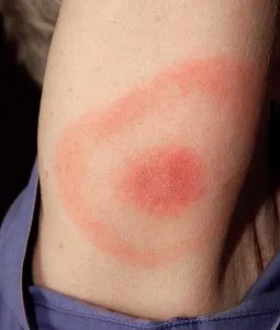 Lyme Hastalığı Nedir? Neden Olur? Belirtileri