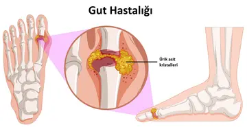 Gut Hastalığı Nedir? Neden Olur?