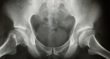 Kalça Kıkırdağında Yırtık – Labrum Yırtığı