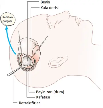 Kafatasından Kemik Çıkarılması – Kraniotomi Nedir? Neden Yapılır?