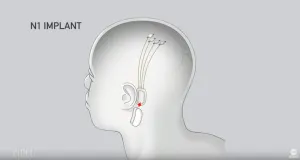 Elon Musk Neuralink Şirketi ile Beyin-Bilgisayar Arayüzü Sorununu Çözmek İstiyor – neuralink4