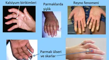 Sistemik Skleroz – Skleroderma Hastalığı Nedir?