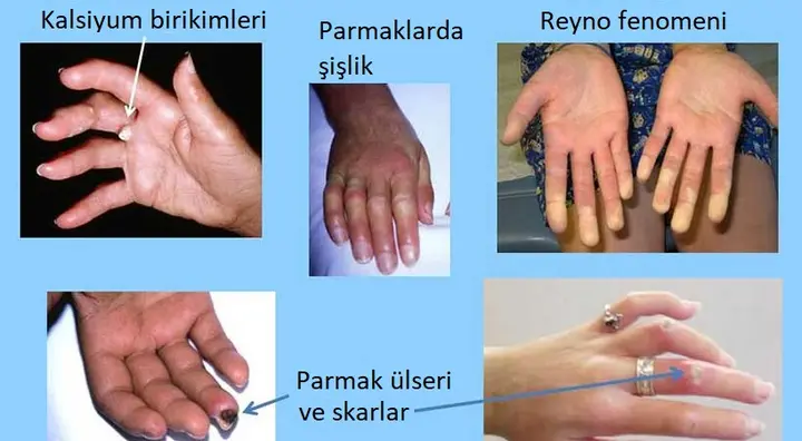 Sistemik Skleroz – Skleroderma Hastalığı Nedir?