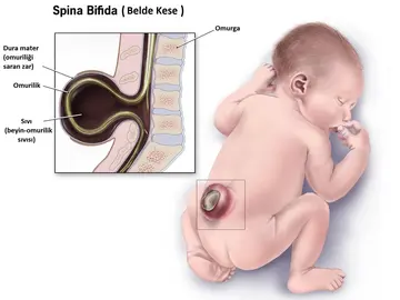 Spina Bifida Nedir? Neden Olur? Fizik Tedavisi