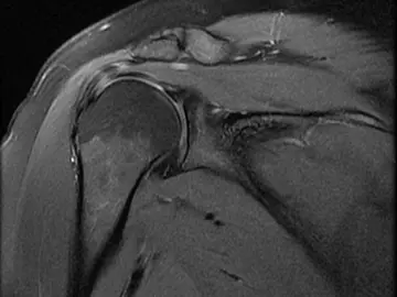 Supraspinatus Tendiniti Nedir? Belirtileri ve Tedavisi