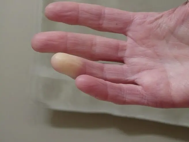 Raynaud Fenomeni – Soğuk Havada Parmaklarda Beyazlaşma ve Morarma