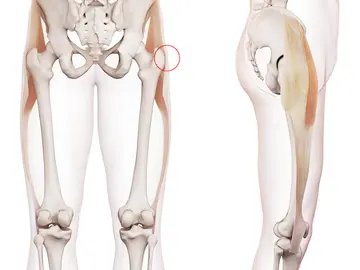 Trokanterik Bursit Nedir? Belirtileri ve Tedavisi