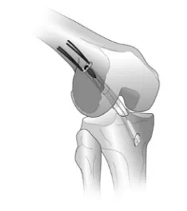 Ön Çapraz Bağ Yırtığı ve Fizik Tedavisi – hamstring tendon grefti