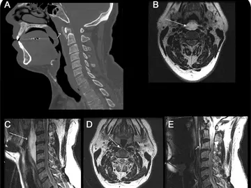 Longus Colli Tendiniti – Tanı ve Tedavi