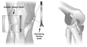 Ön Çapraz Bağ Yırtığı ve Fizik Tedavisi – patellar tendon grefti