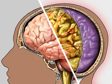 Menenjit Neden Olur? Belirtileri ve Tedavisi Nedir?