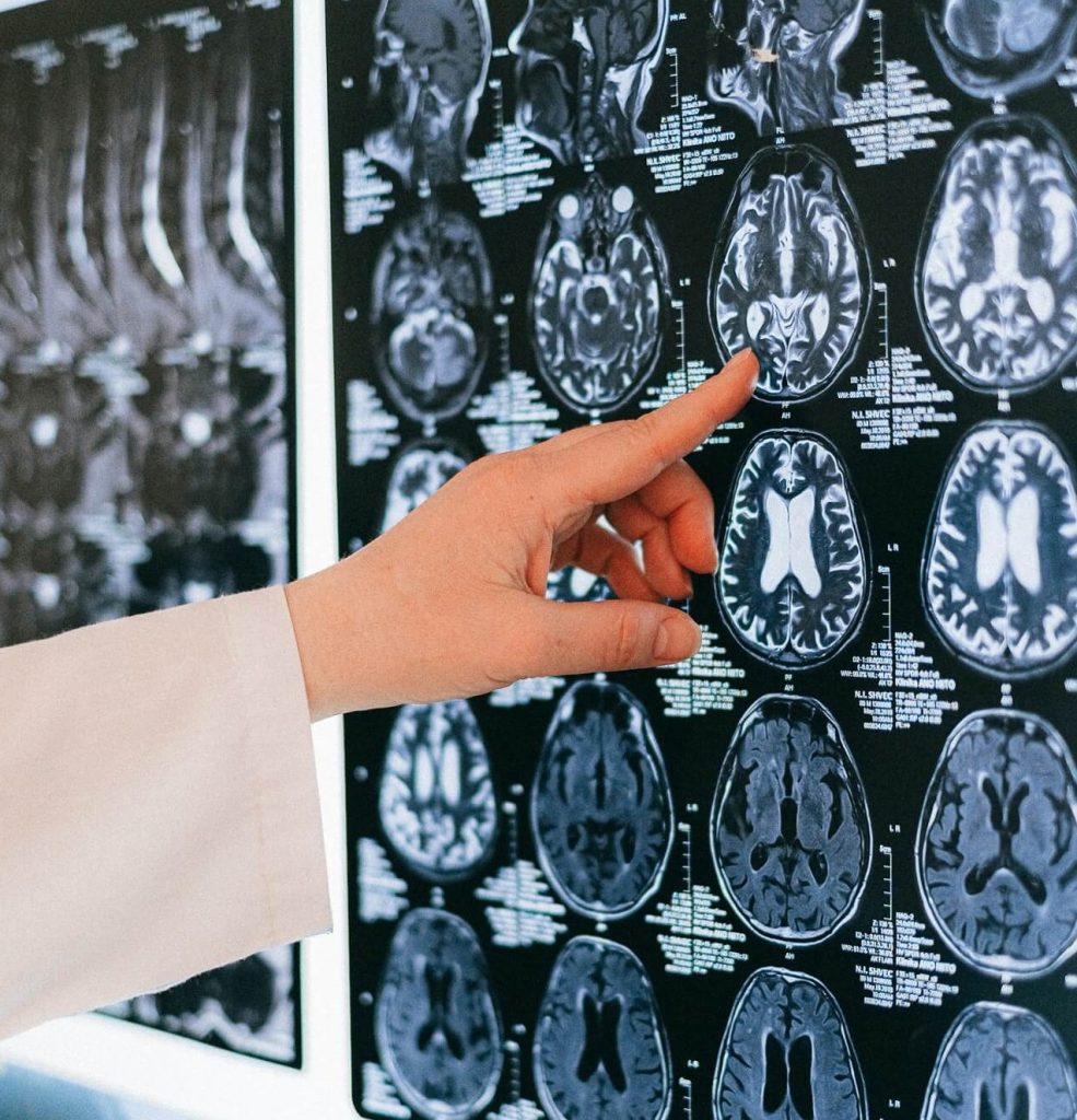 beyin hasarı tedavisinde değerlendirme