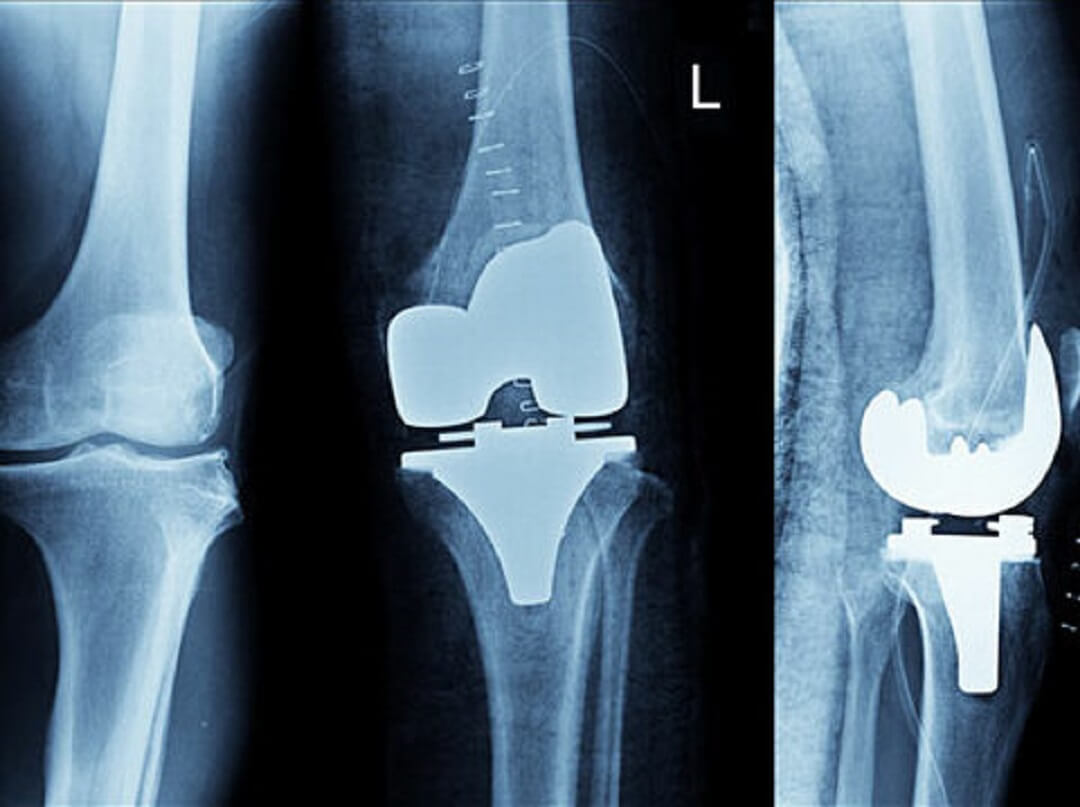 Операции posting. Knee XRAY. Протез коленного сустава. Рентген коленного сустава. Двустороннее эндопротезирование коленных суставов.