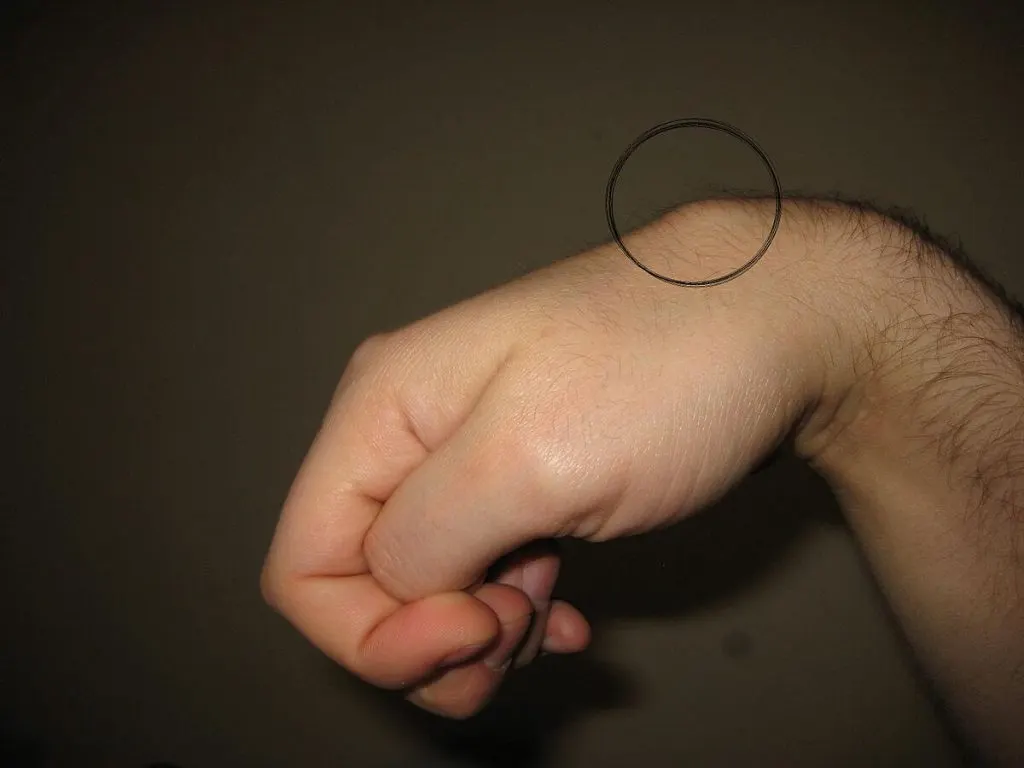El bileği sırtında kireçlenmeye (osteoartrit) bağlı kemik büyümesi olabilir. Buna karpal yumru (carpal boss) denir. El sırtında, bilek eklemine yakın yerde sert, hareketsiz kemik çıkıntı veya şişlik olarak belirti verir. Tek tarafta veya her iki elde oluşabilir. 