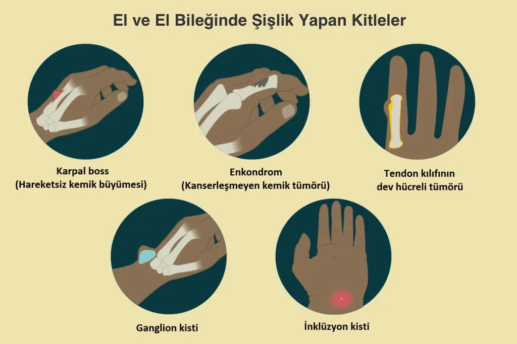 El bileğinde şişlik, zararsız kistlerden kanserlere ve romatizmal hastalıklara kadar pek çok durumdan dolayı olabilir. El bileğinde oluşan şişliğin nedeni eklem sıvısı, eklem zarı kalınlaşması, kemik, kıkırdak veya bağ dokusu büyümesi olabilir. Şişlik bazen hareketlerinizi engelleyebilecek kadar büyük bazen ise sadece dikkatli bir muayene ile anlaşılabilecek kadar belli belirsiz olabilir.