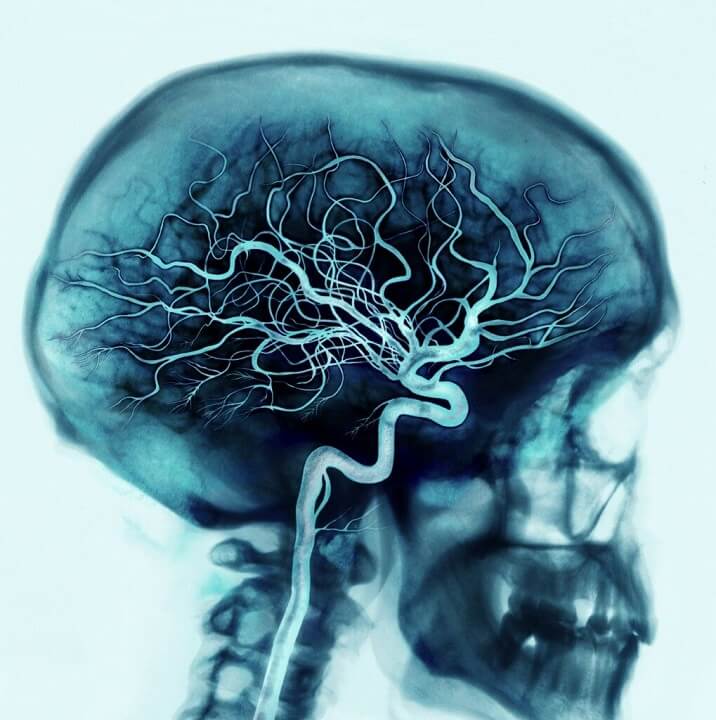İnme, beyni besleyen damarın tıkanması sonucu da meydana gelebilir. İnme tipleri arasında yer alan bu inme tipine iskemik, trombotik inme olarak da adlandırılır. İnme geçiren her 10 hastanın yaklaşık 8’inde sebep damar tıkanması olarak bildirilmektedir (Mozaffarian, Benjamin et al. 2015). 