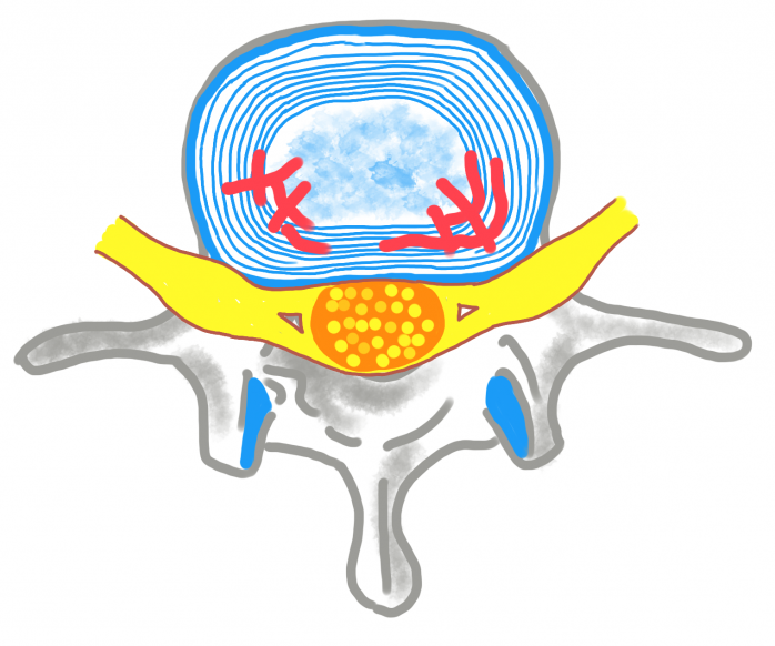 Şekilde annulus fibrozus liflerinde yıpranma ve yırtılmalar kırmızı renkle temsil edilmiştir. Sarı renk sinir dokusunu temsil ediyor.