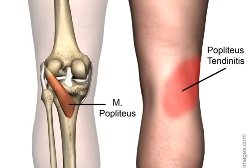 popliteus tendinitis