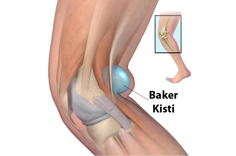 baker kisti