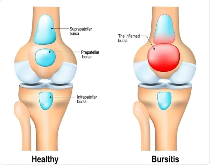 bursitler