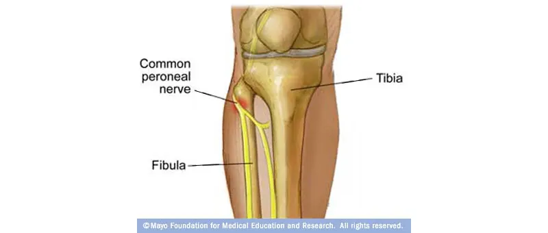 ortak peroneal sinir