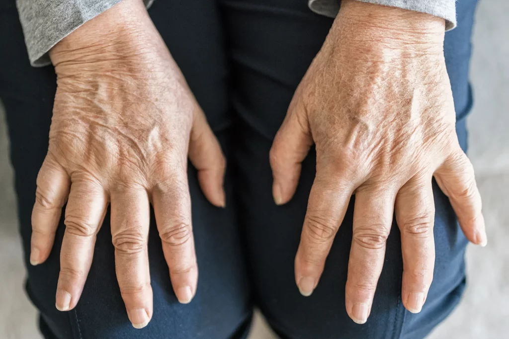 El Bileğinde Şişlik Artrit Kaynaklı Olabilir mi?