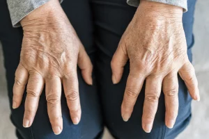 romatoid artrit