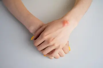 Ganglion Kisti Nedir? Tedavisi Nasıldır?