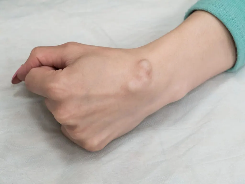Ganglion Kisti