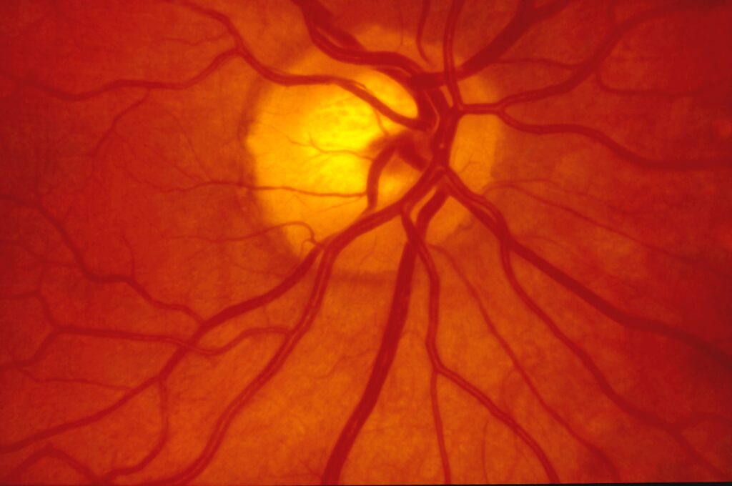 artery shape retina